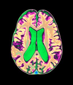 Organophosphate brain damage